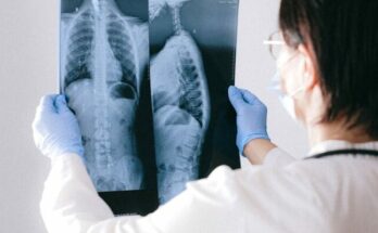 A doctor holding an x ray result